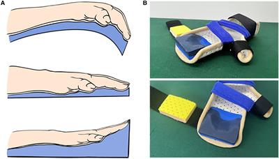 A retrospective study on the correction of distal arthrogryposis with a progressive extension brace